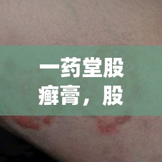 一藥堂股癬膏，股癬的克星，專(zhuān)業(yè)解決方案