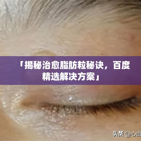 「揭秘治愈脂肪粒秘訣，百度精選解決方案」